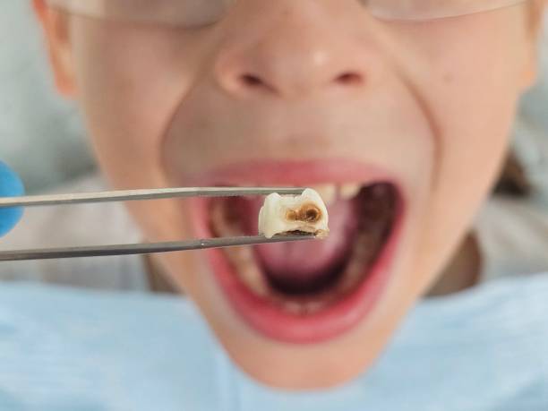Best Emergency Dental Extractions in Frankfort Square, IL